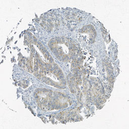 Click to enlarge image Tissue Micro-Array(TMA) core of colon cancer showing cytoplasmic staining using Antibody CPTC-PTPN6-2. Titer: 1:1400