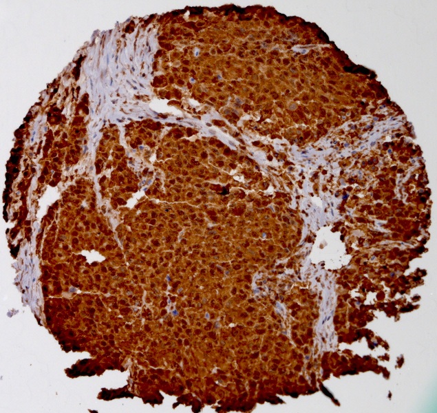 Click to enlarge image Tissue Micro-Array(TMA) core of lung cancer showing cytoplasmic staining using Antibody CPTC-AKR1B1-1. Titer: 1:500