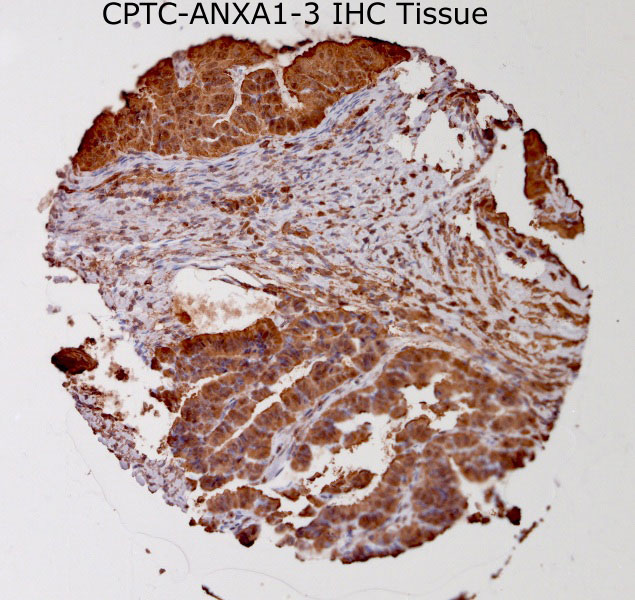 Click to enlarge image Tissue Micro-Array(TMA) core of breast cancer showing cytoplasmic staining using Antibody CPTC-ANXA1-3. Titer: 1:100