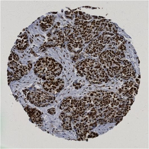 Click to enlarge image Tissue Micro-Array(TMA) core of ovarian cancer  showing nuclear staining using Antibody CPTC-APEX1-2. Titer: 1:5000