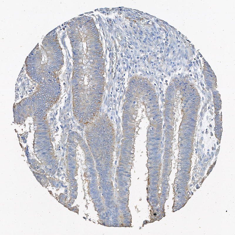 Click to enlarge image Tissue Micro-Array(TMA) core of colon cancer showing cytoplasmic staining using Antibody CPTC-PDLIM1-1. Titer: 1:18000