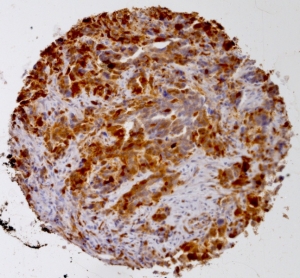 Click to enlarge image Tissue Micro-Array(TMA) core of ovarian cancer showing cytoplasmic staining using Antibody CPTC-S100A4-1. Titer: 1:15000