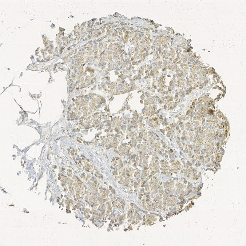 Click to enlarge image Tissue Micro-Array(TMA) core of breast cancer showing cytoplasmic staining using Antibody CPTC-TTR-1. Titer: 1:8000