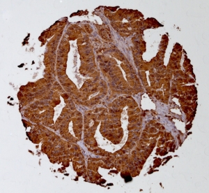 Click to enlarge image Tissue Micro-Array(TMA) core of colon cancer showing cytoplasmic staining using Antibody CPTC IL-18-1. Titer: 1:1000