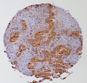 Click to enlarge image Tissue Micro-Array(TMA) core of colon cancer showing cytoplasmic staining using Antibody CPTC-PSAT1-2. Titer: 1:50
