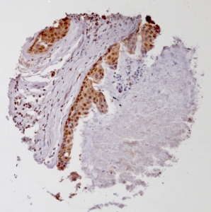 Click to enlarge image Tissue Micro-Array(TMA) core of breast cancer showing cytoplasmic staining using Antibody CPTC-MAGEA4-2. Titer: 1:1250