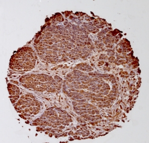 Click to enlarge image Tissue Micro-Array(TMA) core of ovarian cancer showing cytoplasmic staining using Antibody CPTC-ODC1-2. Titer: 1:100