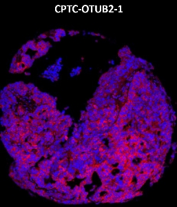 Click to enlarge image Imaging mass cytometry on ovarian cancer tissue core using CPTC-OTUB2-1 metal-labeled antibody.  Data shows an overlay of the target protein signal (red) and DNA (blue). Dilution: 1:100 of 0.5mg/mL stock. Signal was also obtained in other normal tissues (testis, liver, colon, endometrium, appendix, bone marrow, breast, kidney, lung, and placenta) and cancer tissues (breast, colon, prostate, lung, and ovarian).
