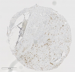 Click to enlarge image Tissue Micro-Array(TMA) core of pancreatic cancer showing nuclear staining using Antibody CPTC-MKi67-3. Titer: 1:6250