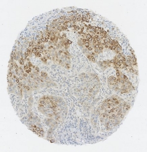 Click to enlarge image IHC of CPTC-AKT3-2 applied to lung cancer.