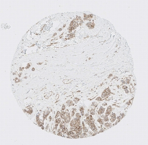 Click to enlarge image Tissue Micro-Array (TMA) core of breast cancer  showing cytoplasmic and membranous staining using Antibody CPTC-EIF2A-1. Titer: 1:50