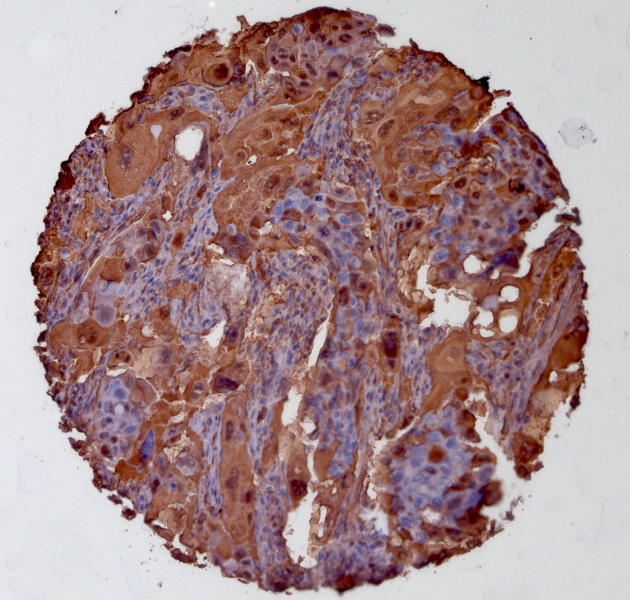 Click to enlarge image Tissue Micro-Array(TMA) core of ovarian cancer showing cytoplasmic staining using Antibody CPTC-ANXA1-1. Titer: 1:4900