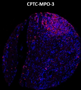 Click to enlarge image Imaging mass cytometry on colon cancer tissue core using CPTC-MPO-3 metal-labeled antibody.  Data shows an overlay of the target protein signal (red) and DNA (blue). Dilution: 1:100 of 0.5mg/mL stock. Signal was also obtained in other normal tissues (testis, liver, colon, endometrium, appendix, bone marrow, breast, kidney, lung, and placenta) and cancer tissues (breast, colon, prostate, lung, and ovarian).