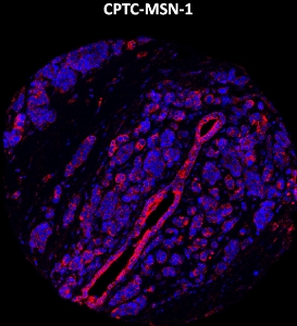 Click to enlarge image Imaging mass cytometry on breast cancer tissue core using CPTC-MSN-1 metal-labeled antibody.  Data shows an overlay of the target protein signal (red) and DNA (blue). Dilution: 1:100 of 0.5mg/mL stock. Signal was also obtained in other normal tissues (liver, bone marrow, spleen, prostate, colon, pancreas, breast, lung, testis, endometrium, and appendix) and cancer tissues (breast, prostate, colon, ovarian, and lung).