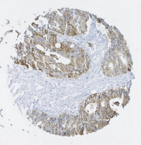 Click to enlarge image Tissue Microarray core of colon cancer immunohistochemically stained with antibody CPTC-EGFR-6.