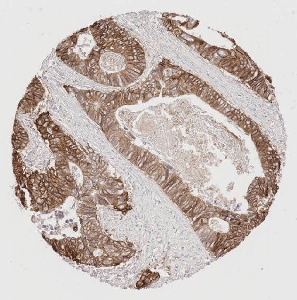 Click to enlarge image Tissue Micro-Array (TMA) core of colon cancer showing cytoplasmic and membranous staining using Antibody CPTC-EGFR-5. Titer: 1:1500