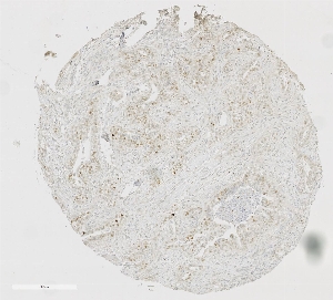 Click to enlarge image Tissue Micro-Array(TMA) core of pancreatic cancer showing nuclear staining using Antibody CPTC-NUMA1-1. Titer: 1:1250