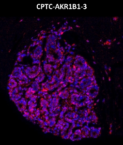 Click to enlarge image Imaging mass cytometry on breast cancer tissue core using CPTC-AKR1B1-3 metal-labeled antibody.  Data shows overlay of target protein signal (red) and DNA (blue). Dilution: 1:100 of 0.5mg/mL stock. Signal was also obtained in other normal tissues (testis, prostate, liver, colon, and endometrium) and cancer tissues (breast, colon, prostate, lung, and ovarian).