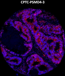 Click to enlarge image Imaging mass cytometry on colon cancer tissue core using CPTC-PSMD4-3 metal-labeled antibody.  Data shows an overlay of the target protein signal (red) and DNA (blue). Dilution: 1:100 of 0.5mg/mL stock. Signal was also obtained in other normal tissues (liver, spleen, placenta, prostate, colon, pancreas, breast, lung, testis, endometrium, appendix, and kidney) and cancer tissues (breast, colon, ovarian, lung, and prostate).