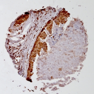 Click to enlarge image Tissue Micro-Array(TMA) core of breast cancer showing cytoplasmic staining using Antibody CPTC-MAGEA4-1. Titer: 1:100