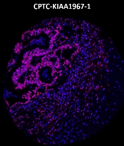 Click to enlarge image Imaging mass cytometry on colon cancer tissue core using CPTC-KIAA1967-1 metal-labeled antibody.  Data shows an overlay of the target protein signal (red) and DNA (blue). Dilution: 1:100 of 0.5mg/mL stock. Signal was also obtained in other normal tissues (testis, prostate, liver, colon, endometrium, appendix, pancreas, bone marrow, breast, kidney, lung, and placenta) and cancer tissues (breast, lung, prostate, colon and ovarian).