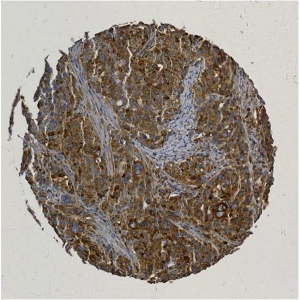 点击放大图像，显示使用抗体CPTC-MSN-3进行细胞质染色的卵巢癌组织微阵列（TMA）核心。标题：1:15000