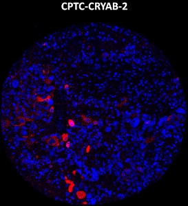 Click to enlarge image Imaging mass cytometry on ovarian cancer tissue core using CPTC-CRYAB-2 metal-labeled antibody.  Data shows an overlay of the target protein signal (red) and DNA (blue). Dilution: 1:100 of 0.5mg/mL stock. Signal was also obtained in other normal tissues (appendix and kidney) and cancer tissues (ovarian and prostate).