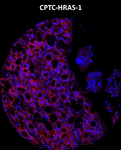 Click to enlarge image Imaging mass cytometry on lung cancer tissue core using CPTC-HRAS-1 metal-labeled antibody.  Data shows overlay of target protein signal (red) and DNA (blue). Dilution: 1:100 of 0.5mg/mL stock. Signal was also obtained in other normal tissues (testis, prostate, liver, colon, endometrium, appendix, pancreas, bone marrow, breast, kidney, lung, and placenta) and cancer tissues (breast, colon, prostate, lung, and ovarian).