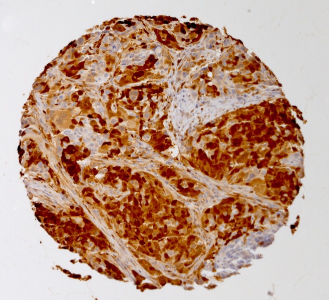 Click to enlarge image Tissue Micro-Array(TMA) core of ovarian cancer showing cytoplasmic staining using Antibody CPTC-S100A4-3. Titer: 1:7500