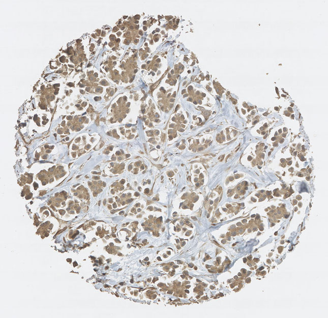 Click to enlarge image Tissue Micro-Array(TMA) core of breast cancer showing cytoplasmic staining using Antibody CPTC-ABCB1-2. Titer: 1:100
