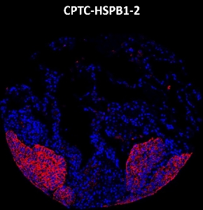Click to enlarge image Imaging mass cytometry on lung cancer tissue core using CPTC-HSPB1-2 metal-labeled antibody.  Data shows an overlay of the target protein signal (red) and DNA (blue). Dilution: 1:100 of 0.5mg/mL stock. Signal was also obtained in other normal tissues (prostate, liver, colon, endometrium, appendix, pancreas, breast, kidney, lung, and placenta) and cancer tissues (breast, colon, prostate, lung, and ovarian).