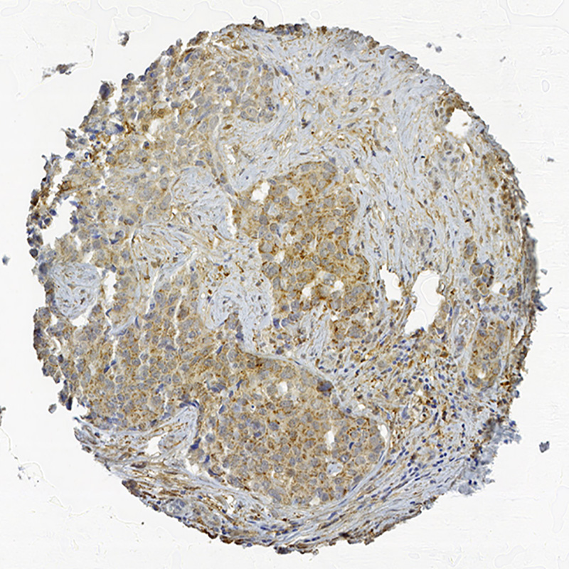 Click to enlarge image Tissue Micro-Array(TMA) core of breast cancer showing cytoplasmic staining using Antibody CPTC-EBAG9-1. Titer: 1:4000