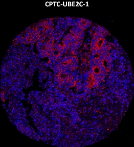 Click to enlarge image Imaging mass cytometry on colon cancer tissue core using CPTC-UBE2C-1 metal-labeled antibody.  Data shows an overlay of the target protein signal (red) and DNA (blue). Dilution: 1:100 of 0.5mg/mL stock. Signal was also obtained in other normal tissues (liver, bone marrow, colon, pancreas, lung testis, and endometrium, appendix, and kidney) and cancer tissues (breast and colon).