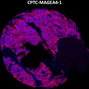 Click to enlarge image Imaging mass cytometry on ovarian cancer tissue core using CPTC-MAGEA4-1 metal-labeled antibody.  Data shows an overlay of the target protein signal (red) and DNA (blue). Dilution: 1:100 of 0.5mg/mL stock. Signal was also obtained in other cancer tissues (breast, ovarian, lung, and prostate).