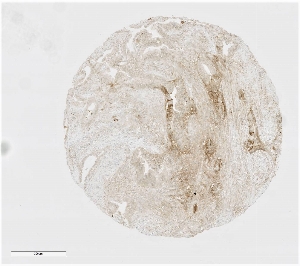 Click to enlarge image Tissue Micro-Array(TMA) core of pancreatic cancer showing cytoplasmic staining using Antibody CPTC-MRE11A-1. Titer: 1:250