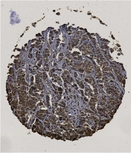 Click to enlarge image Tissue Micro-Array(TMA) core of breast cancer  showing cytoplasmic staining using Antibody CPTC-CHP2-1. Titer: 1:20000