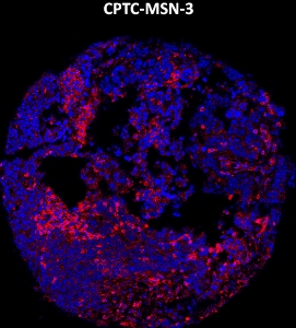 Click to enlarge image Imaging mass cytometry on ovarian cancer tissue core using CPTC-MSN-3 metal-labeled antibody.  Data shows an overlay of the target protein signal (red) and DNA (blue). Dilution: 1:100 of 0.5mg/mL stock. Signal was also obtained in other normal tissues (liver, bone marrow, spleen, prostate, colon, pancreas, breast, lung, testis, endometrium, and appendix) and cancer tissues (breast, prostate, colon, ovarian, and lung).