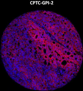 Click to enlarge image Imaging mass cytometry on ovarian cancer tissue core using CPTC-GPI-2 metal-labeled antibody.  Data shows an overlay of the target protein signal (red) and DNA (blue). Dilution: 1:100 of 0.5mg/mL stock. Signal was also obtained in other normal tissues (liver, bone marrow, spleen, prostate, colon, pancreas, breast, lung, testis, endometrium, appendix, and kidney) and cancer tissues (colon, breast, ovarian, lung, and prostate).