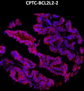 点击放大图像，使用CPTC-BCL2L2-2金属标记抗体对卵巢癌组织核心进行成像质量细胞术。数据显示目标蛋白信号（红色）和DNA（蓝色）重叠。稀释：1:100的0.5mg/mL原液。在其他正常组织（胰腺、肺、睾丸、子宫内膜和肾脏）和癌组织（结肠、卵巢、肺和前列腺）中也获得了信号。