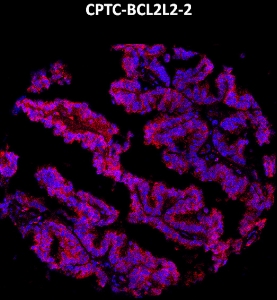 Click to enlarge image Imaging mass cytometry on ovarian cancer tissue core using CPTC-BCL2L2-2 metal-labeled antibody.  Data shows an overlay of the target protein signal (red) and DNA (blue). Dilution: 1:100 of 0.5mg/mL stock. Signal was also obtained in other normal tissues (pancreas, lung, testis, endometrium, and kidney) and cancer tissues (colon, ovarian, lung, and prostate).