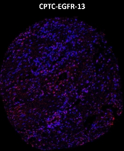 Click to enlarge image Imaging mass cytometry on colon cancer tissue core using CPTC-EGFR-13 metal-labeled antibody.  Data shows an overlay of the target protein signal (red) and DNA (blue). Dilution: 1:100 of 0.5mg/mL stock. Signal was also obtained in other normal tissues (colon and kidney) and cancer tissues (colon, lung, and ovarian).