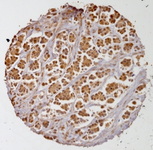 Click to enlarge image Tissue Micro-Array (TMA) core of breast cancer showing cytoplasmic staining using Antibody CPTC-IL18-3.