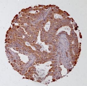 Click to enlarge image Tissue Micro-Array(TMA) core of colon cancer showing cytoplasmic staining using Antibody CPTC-UBE2C-1. Titer: 1:250