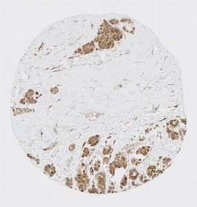 Click to enlarge image Tissue Micro-Array (TMA) core of breast cancer  showing cytoplasmic and nuclear staining using Antibody CPTC-YAP1-2. Titer: 1:1000