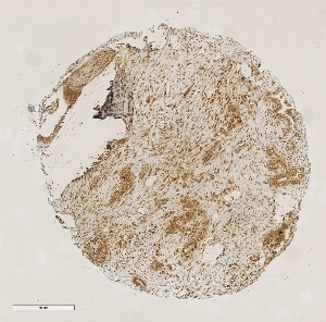 Click to enlarge image Tissue Micro-Array(TMA) core of pancreatic cancer showing nuclear staining using Antibody CPTC-RTF1-2. Titer: 1:50