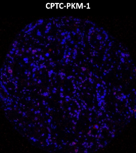 Click to enlarge image Imaging mass cytometry on lung cancer tissue core using CPTC-PKM-1 metal-labeled antibody.  Data shows overlay of target protein signal (red) and DNA (blue). Dilution: 1:100 of 0.5mg/mL stock. Signal was also obtained in other normal tissues (appendix) and cancer tissues (colon and ovarian).