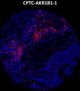 点击放大图像，使用CPTC-AKR1B1-1金属标记抗体对肺癌组织核心进行成像质量细胞术。数据显示目标蛋白信号（红色）和DNA（蓝色）重叠。稀释：0.5mg/mL储备液的1:100。在其他正常组织（阑尾和肾脏）和癌组织（乳腺、肺和卵巢）中也获得了信号。