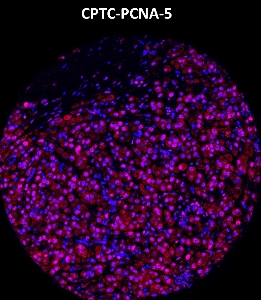 Click to enlarge image Imaging mass cytometry on breast cancer tissue core using CPTC-PCNA-5 metal-labeled antibody.  Data shows overlay of target protein signal (red) and DNA (blue). Dilution: 1:100 of 0.5mg/mL stock. Signal was also obtained in other normal tissues (testis, prostate, liver, colon, endometrium, appendix, pancreas, bone marrow, breast, kidney, lung, and placenta) and cancer tissues (colon, prostate, lung, and ovarian).