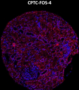 Click to enlarge image Imaging mass cytometry on normal kidney tissue core using CPTC-FOS-4 metal-labeled antibody.  Data shows an overlay of the target protein signal (red) and DNA (blue). Dilution: 1:100 of 0.5mg/mL stock. Signal was also obtained in other normal tissues (liver, bone marrow, prostate, colon, pancreas, breast, lung, testis, endometrium, appendix, and kidney) and cancer tissues (colon, breast, ovarian, lung, and prostate).