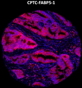 Click to enlarge image Imaging mass cytometry on colon cancer tissue core using CPTC-FABP5-1 metal-labeled antibody.  Data shows an overlay of the target protein signal (red) and DNA (blue). Dilution: 1:100 of 0.5mg/mL stock. Signal was also obtained in other normal tissues (liver, bone marrow, spleen, placenta, prostate, colon, pancreas, breast, lung, testis, endometrium, appendix, and kidney) and cancer tissues (colon, breast, ovarian, lung, and prostate).